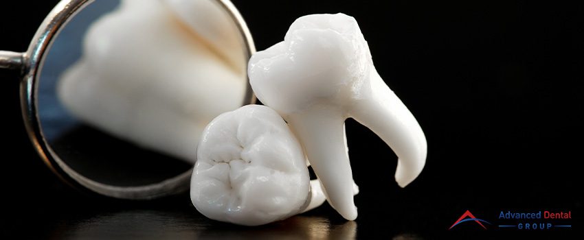 A Question for Wisdom Teeth - To Pull or Not To Pull