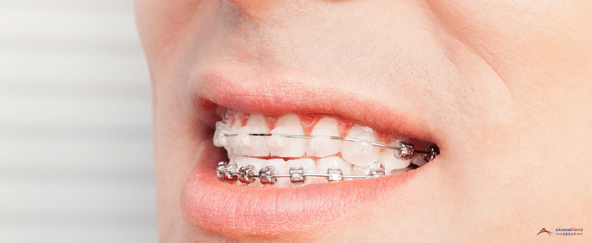 ADG-Man`s smile with dental braces on teeth