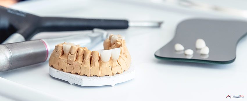 ADG-Production of dental veneers and crowns