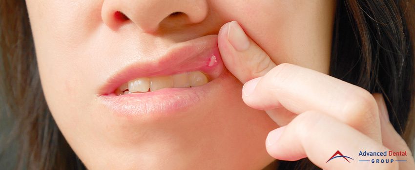 Canker Sores and What You Can Do About Them