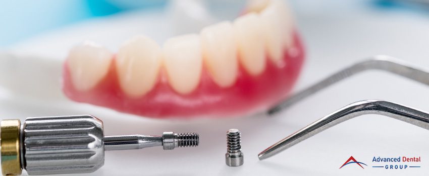 Dental Implants - What To Expect Before the Procedure