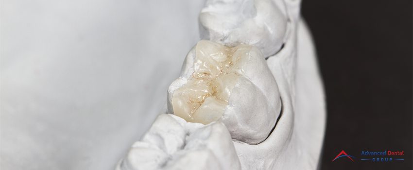 Dental Inlay - When Does It Become Your Best Option