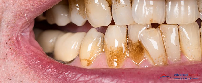 Everything You Need to Know About Receding Gums