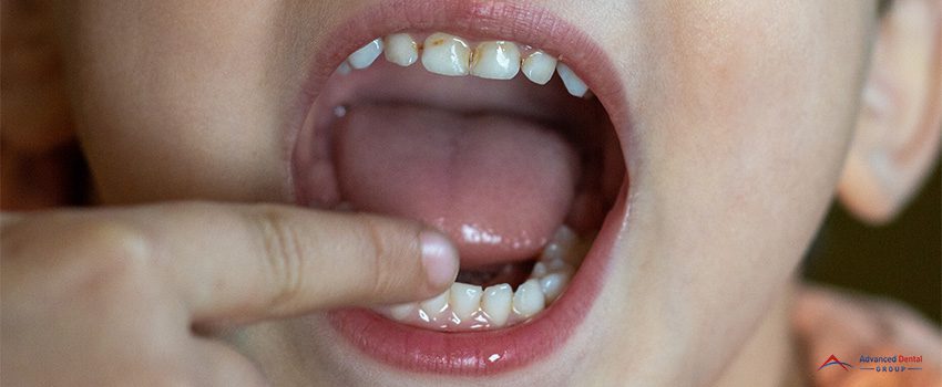 How to Prevent Cavities in Children