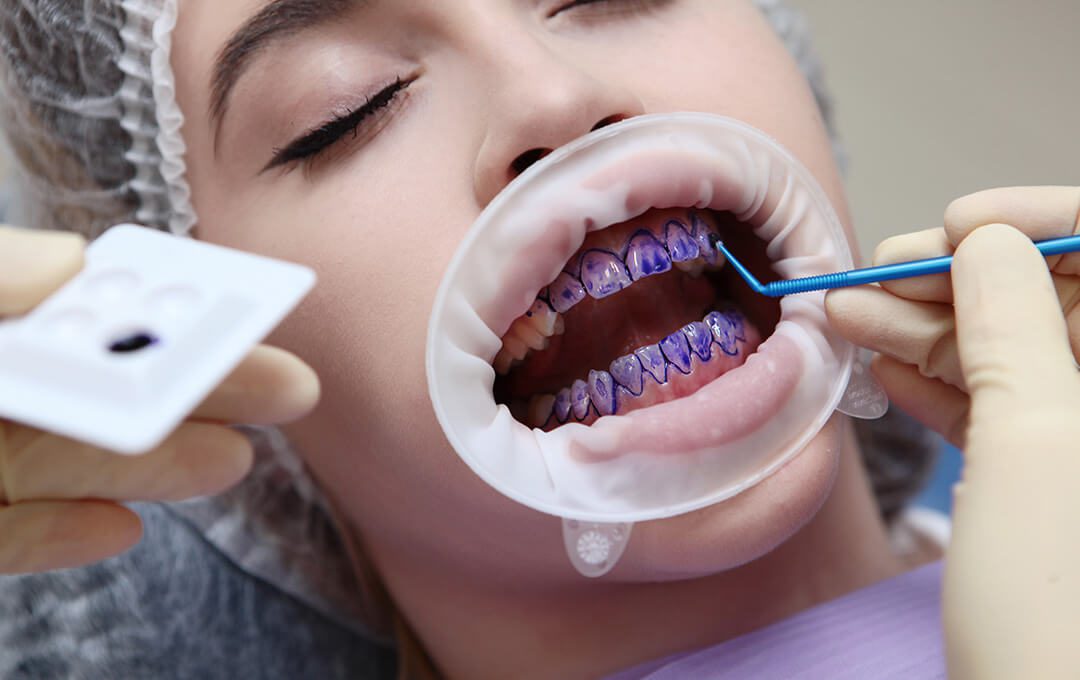 ADG Dental Cleaning