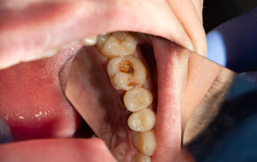 ADG  Considered Dental Fillings