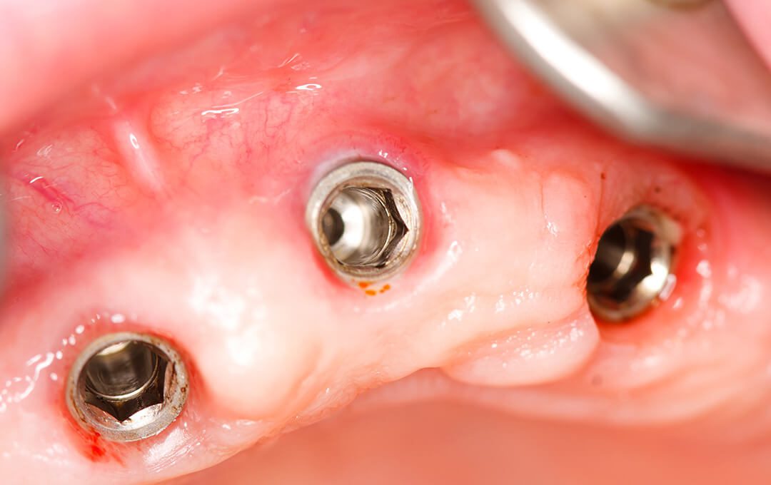 ADG Dental Implants