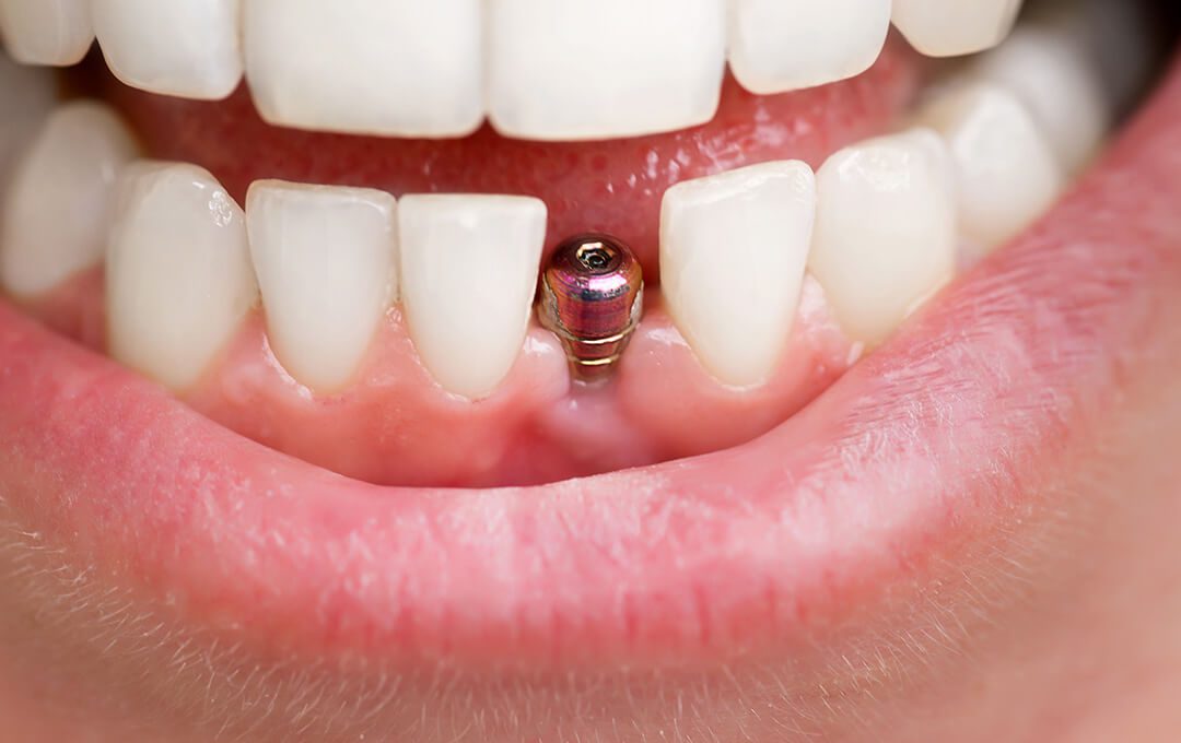 ADG Getting Dental Implants
