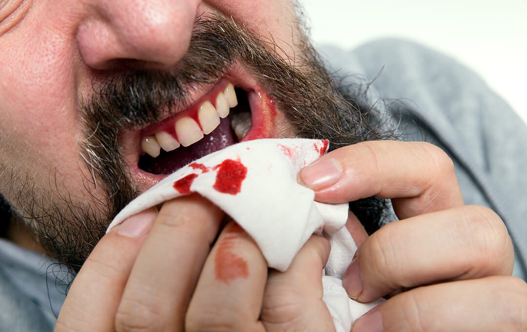 ADG Gum Bleeding
