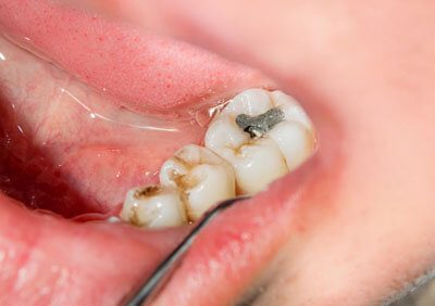 ADG Tooth Cavities Treatment in Jordan UT
