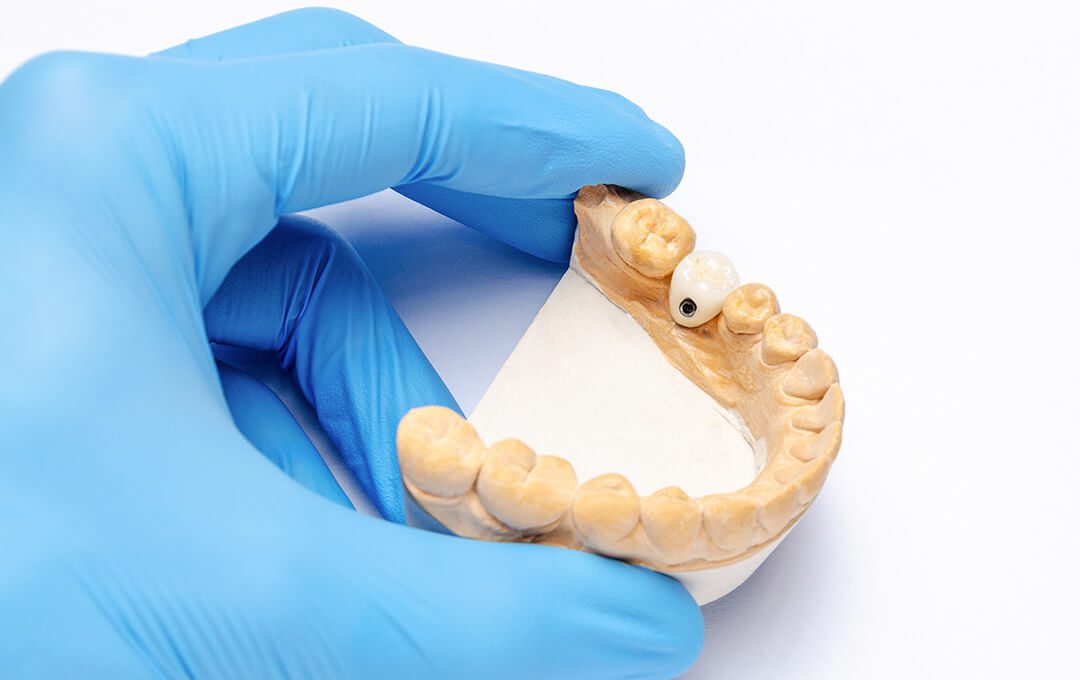 ADG Types of Dental Crowns
