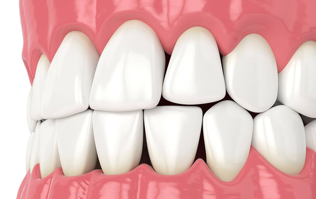 ADG What is Dental Bonding